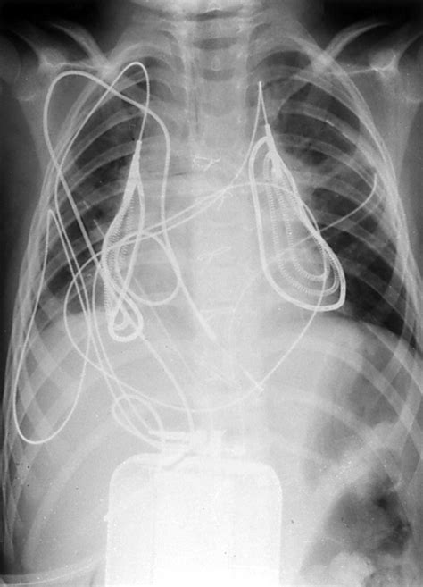 Growth And The Implantable Cardioverter Defibrillator Heart