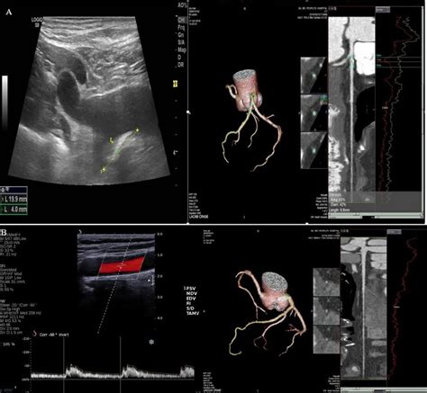 Left Panel B Mode Image Showing The Right Subclavian Plaque Right