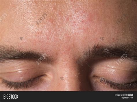 Weeping Eczema Stage Image And Photo Free Trial Bigstock