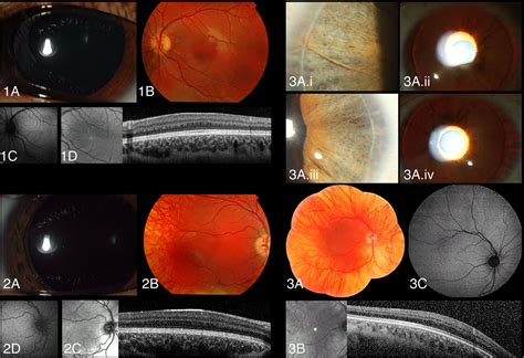 The ophthalmic presentation of Hermansky–Pudlak syndrome 6 | British ...
