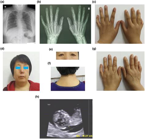 Clinical Features And Images Of The Subjects Ac Images Of Xray