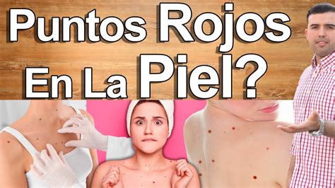 Lunares Y Puntos Rojos Sobre Tu Piel EN VIVO Que Significan Y Como