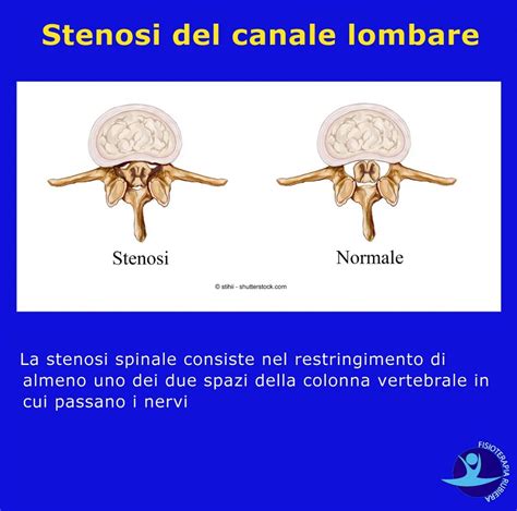 Stenosi Del Canale Lombare Sintomi Cause E Come Riconoscerla