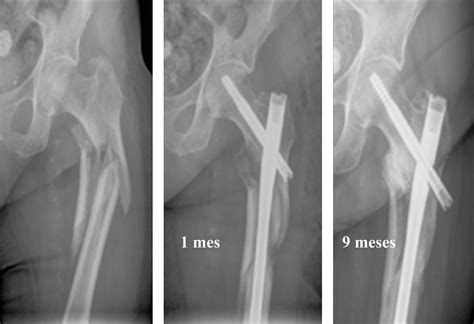 Gamma Nail Surgery Nail Ftempo