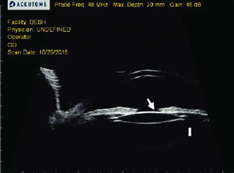 Ultrasound Biomicroscopy Image Showing The Hyperflexed Posterior