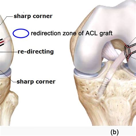 Femoral And Tibial Tunnel Entrances Divided Into Four Zones Download Scientific Diagram