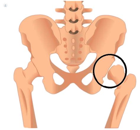 Displasia De Cadera Qu Es S Ntomas Y Tratamiento Top Doctors