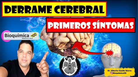 Estos Son Los Primeros Sintomas De Un Derrame Cerebral Se Ales Que