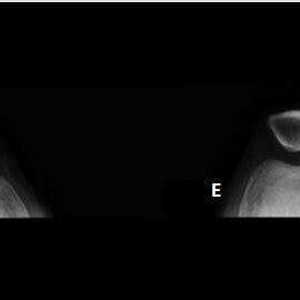 Radiografia Do Paciente P4 Joelho Direito D E Esquerdo E