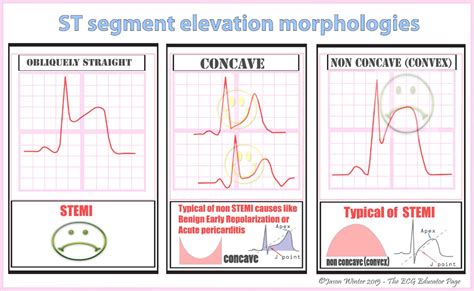 ST Segment Elevation Morphologies #Diagnosis #Cardiology ... Grad School, Medical School ...