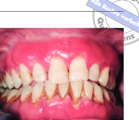 Swollen And Erythematous Gingiva Extends To The Mucogingival Junction