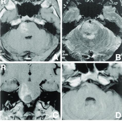 Case A Preoperative Axial T Weighted Magnetic Resonance Mr