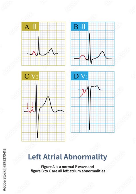 Changes such as left atrial enlargement, increased pressure in the left atrium, fibrosis or ...