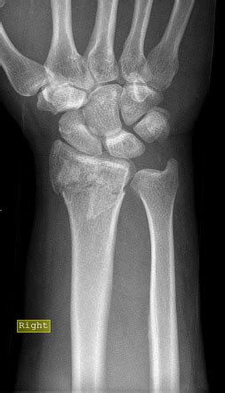 Distal Radial Fracture Radiology Case Radiopaedia Org