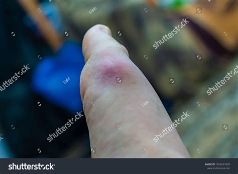 Large Hematoma On Leg Swollen Joint Stock Photo Shutterstock