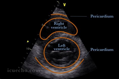 Parasternal Short Axis ICU Echo