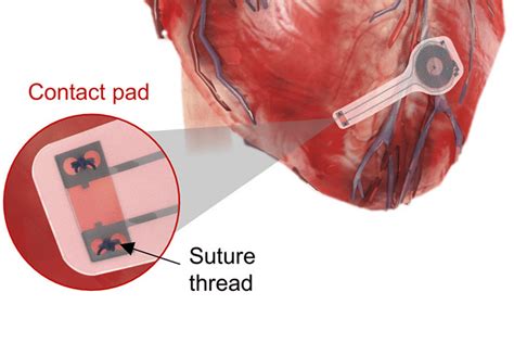 New Pacemaker Disappears When No Longer Needed