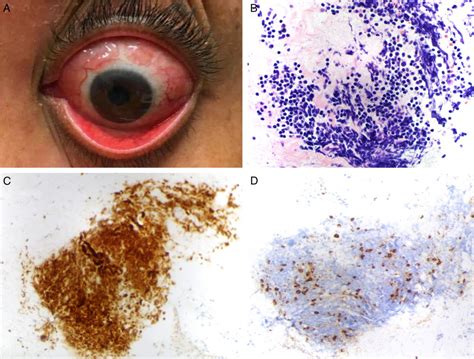 Conjunctival Lymphoma