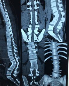 Kyphosis | Best diagnosis and treatment in Mumbai