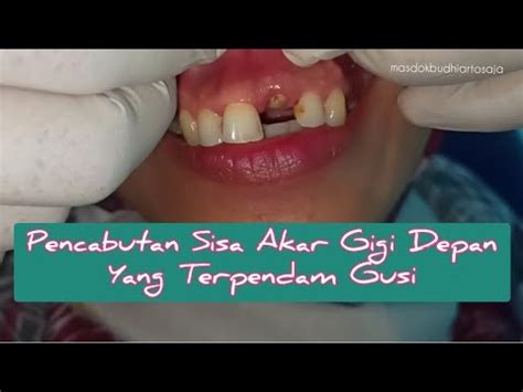 Sisa Akar Terpendam Gigi Depan Atas Sering Bikin Bengkak Gusi Dan Bibir