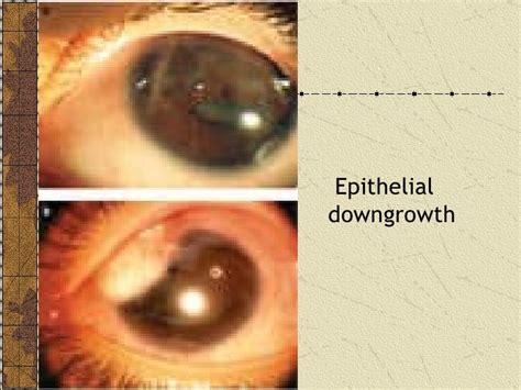 CATARACT SURGERY COMPLICATIONS