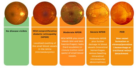 Diabetic Retinopathy – Causes, Symptoms, Risks & Prevention - Vision 2020 | Diabeticeye.lk