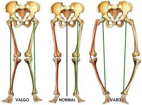 LOS PROBLEMAS ORTOPEDICOS MAS COMUNES EN NIÑOS Cirugia de Columna en