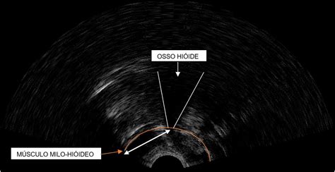 SciELO Brasil Análise ultrassonográfica da distância do osso hioide