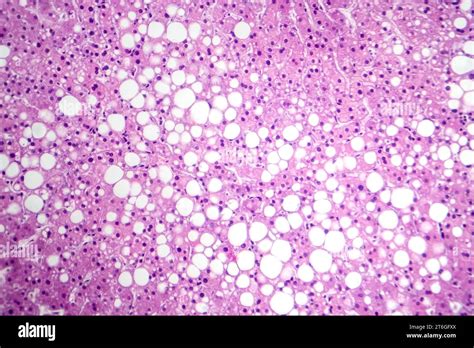 Photomicrograph Of Hepatic Steatosis Revealing Fat Accumulation In