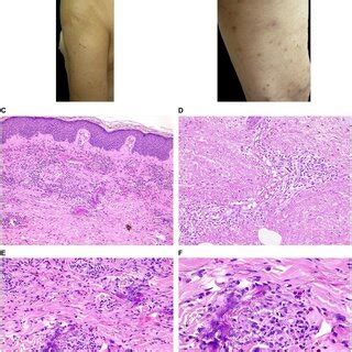 Clinical And Histopathological Features Of EDHM In Patient 9 A B