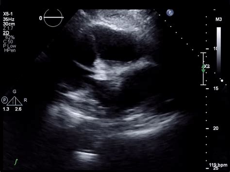 Pericardial Effusion Hematoma R Sonographers