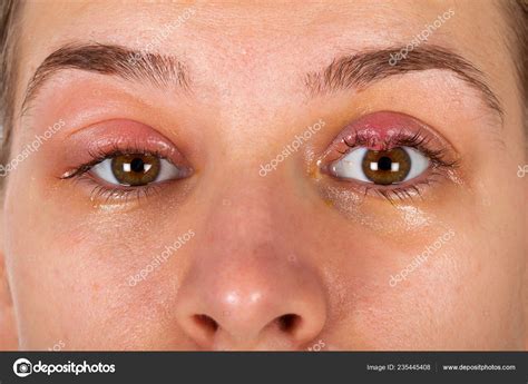 Close Picture Upper Eyelid Inflammation Chalazion Young Female