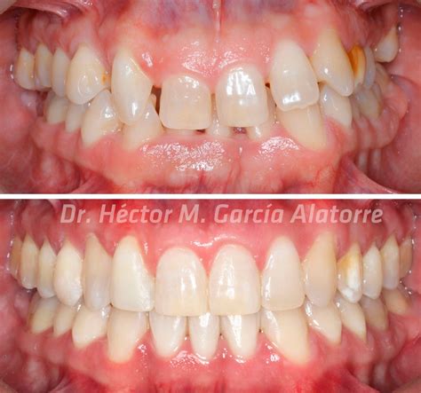 Invisalign Antes y Después Invisalign en Ciudad de México