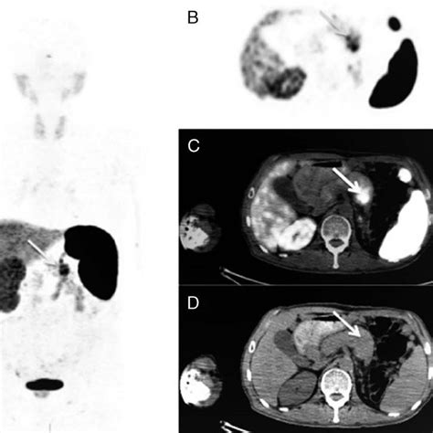 PDF 68Ga DOTATATE Uptake In Pancreatic Metastasis Of Renal Cell