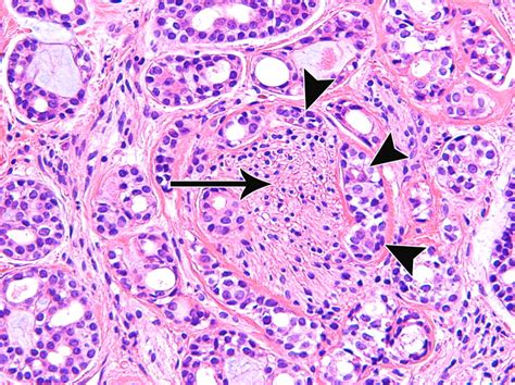 Airp Best Cases In Radiologic Pathologic Correlation Adenoid Cystic Carcinoma Of The Trachea