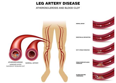 Peripheral Vascular Disease Understanding The Basics Cora