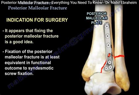 Posterior Malleolar Ankle Fracture — OrthopaedicPrinciples.com