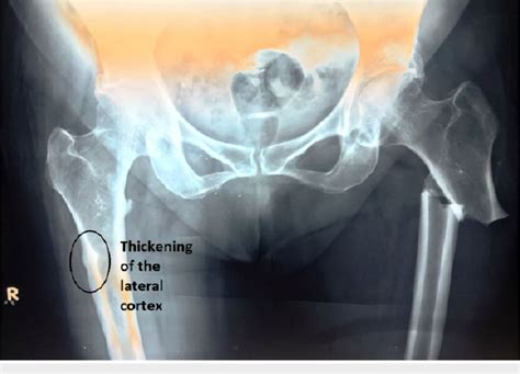 X Ray Pelvis With Hips Antero Posterior View Showing Subtrochanteric