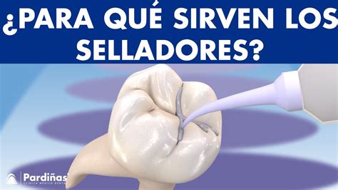 Selladores Dentales Sellado De Fosas Y Fisuras Para Prevenir Caries