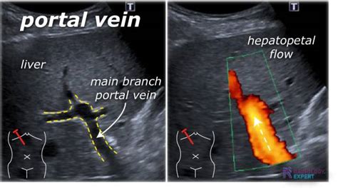 Liver Ultrasound Anatomy