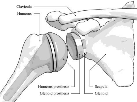 Illustration of a shoulder after an arthroplasty. Both the humeral head ...