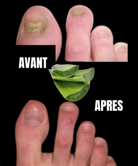 Traitement naturel contre les champignons des ongles lAloe Vera à la