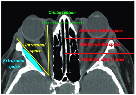 Orbital Septum Anatomy