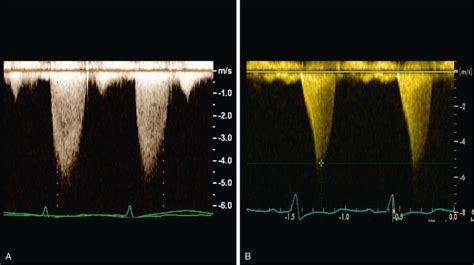 Aortic Stenosis Clinical Presentation Disease Stages And Timing Of