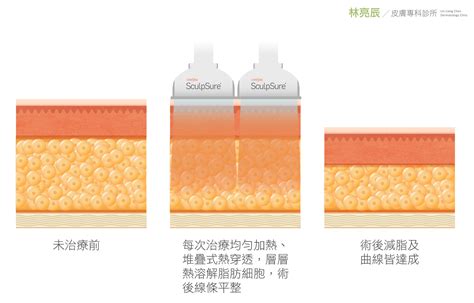 【sculpsure】sculpsure絲酷秀體外雷射減脂 到底要做幾次？ 林亮辰皮膚專科診所 Bright Skin