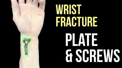 Broken Wrist - Plate and Screws - YouTube