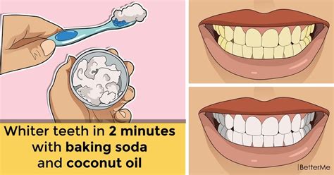 How To Whiten Teeth With Coconut Oil And Baking Soda Teeth Poster