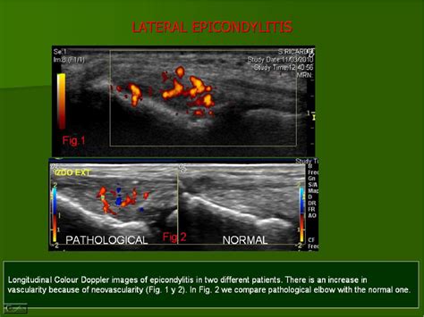 Figure From Ultrasound Of The Elbow What The Radiologist Should