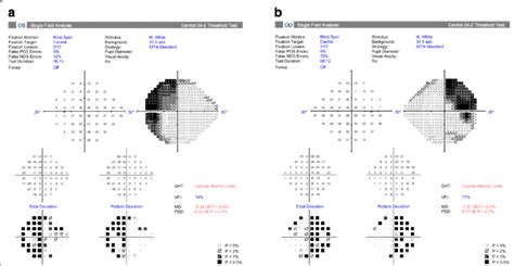 Humphrey Sita Standard Visual Field Test Result For Patient S Left