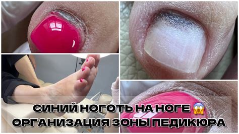 СИНЯК НА НОГТЕ😥хочу обучиться на ПОДОЛОГА💜Что нужно чтобы делать ...